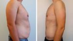 tiago rufino antes depois cirurgia 1 Tiago Rufino no "Você na TV" para mostrar a transformação corporal incrível. Com fotos
