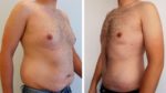 tiago rufino antes depois cirurgia 2 Tiago Rufino no "Você na TV" para mostrar a transformação corporal incrível. Com fotos