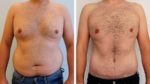 tiago rufino antes depois cirurgia 3 Tiago Rufino no "Você na TV" para mostrar a transformação corporal incrível. Com fotos