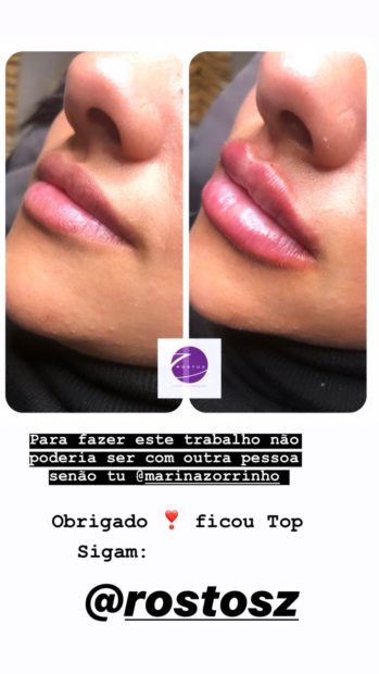 joana diniz labios Joana Diniz mostra os seus novos lábios: "Ficou top"