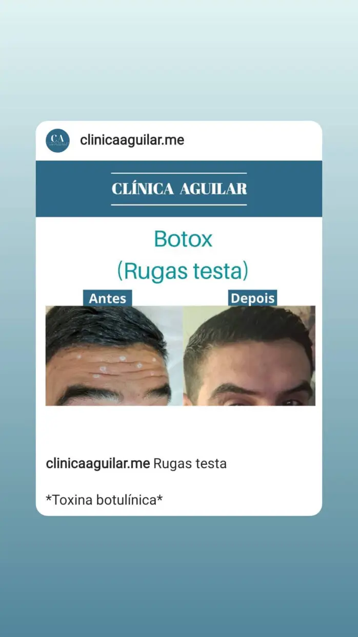 Lucas-Rocha-Casados-A-Primeira-Vista-Botox
