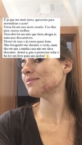sara-barros-leitao-instastory-acne